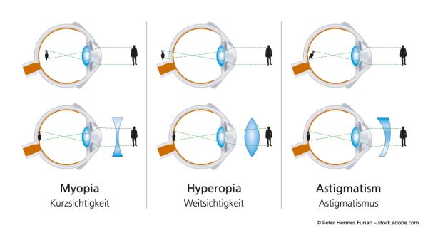 Erklärgrafik Fehlsichtigkeiten